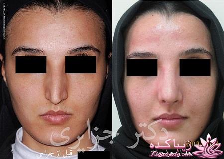 جراحی بینی - جراحی زیبایی